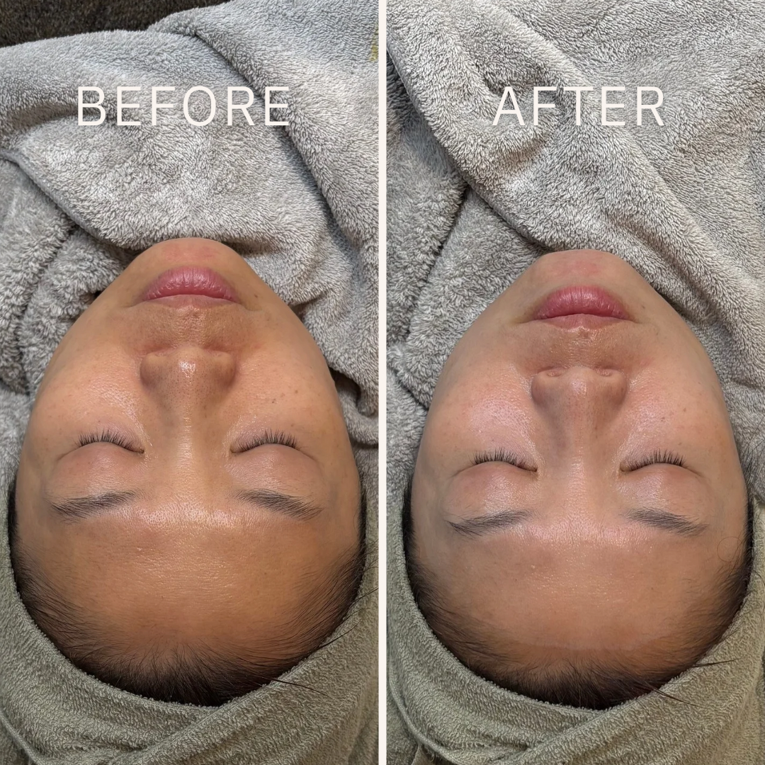 Black and White Minimalist Before After Beauty Instagram Postのコピー (1)