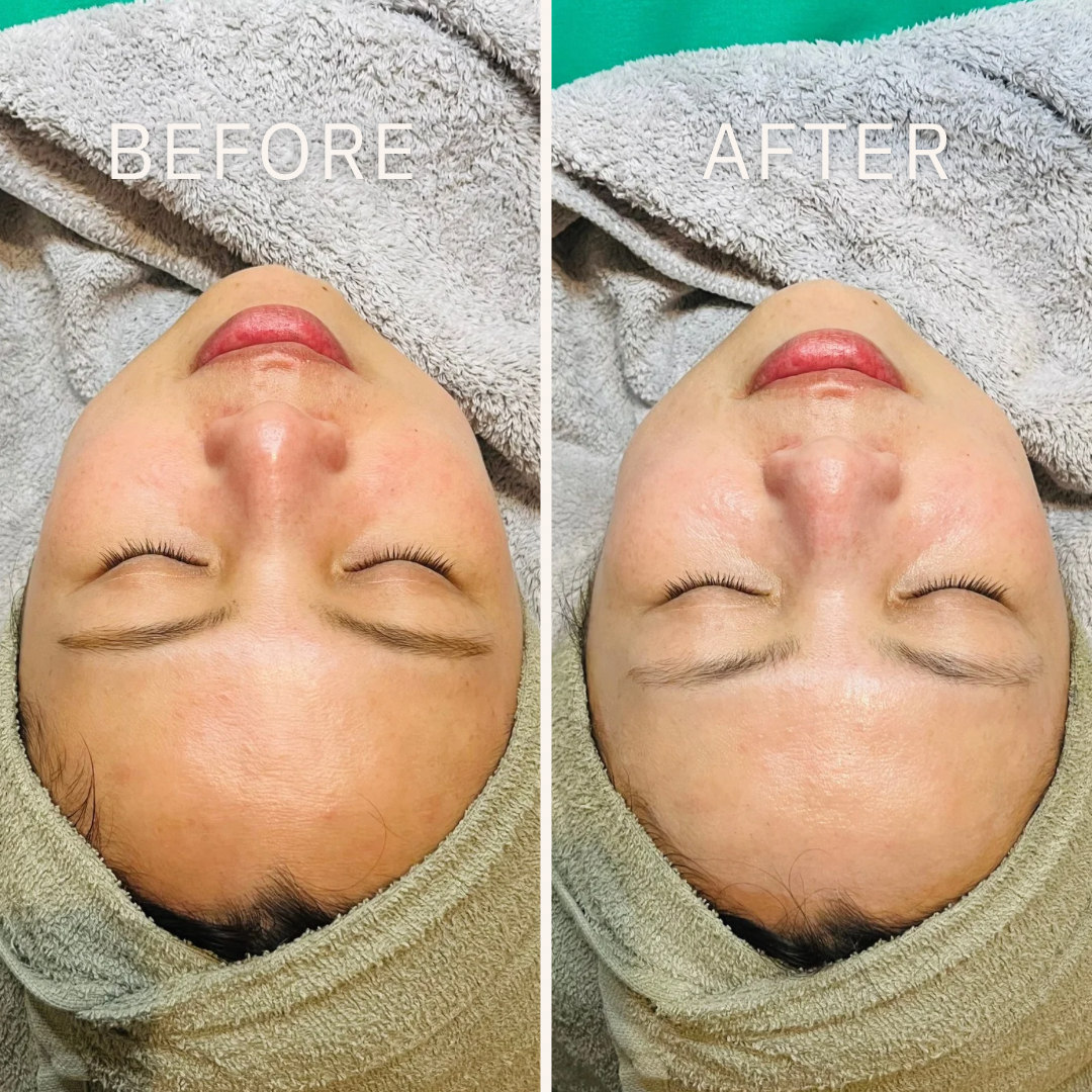 Black and White Minimalist Before After Beauty Instagram Postのコピーのコピー